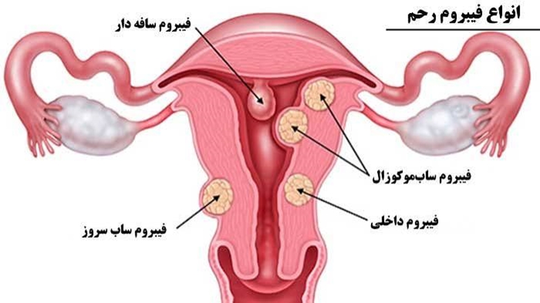 فیبروم‌های رحمی؛ از خون‌ریزی‌های غیرطبیعی تا اختلال در باروری